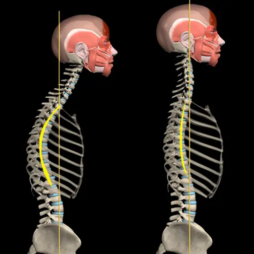 Kyphosis & Rounded Back by M&M icon